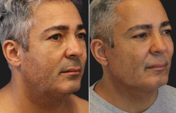 51 year-old male before and 2 months after comprehensive facial rejuvenation with Dr. Munique Maia in Tysons Corner, Virginia Healing In Progress, right oblique view