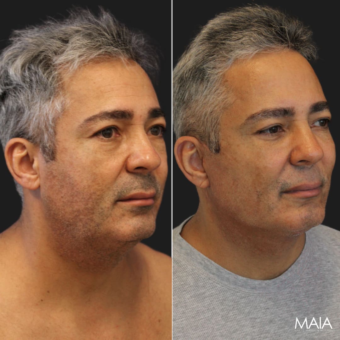 51 year-old male before and 2 months after comprehensive facial rejuvenation with Dr. Munique Maia in Tysons Corner, Virginia Healing In Progress, right oblique view