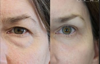 Before and 3 months after