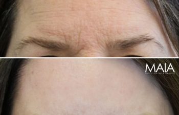 Before and 3 months after