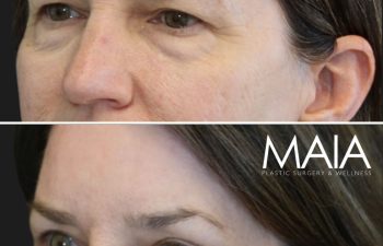 Before and 3 months after