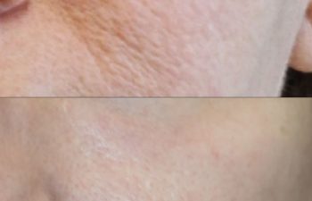 Before and 3 months after