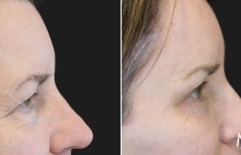 Before and 3 months after