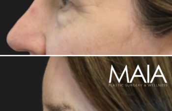 Before and 3 months after