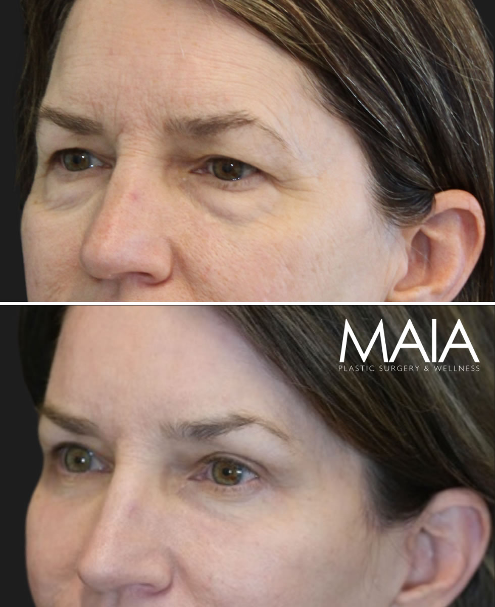 Before and 3 months after