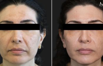 44 year-old patient before and 1 month after HALO and 3 sessions of Microneedling