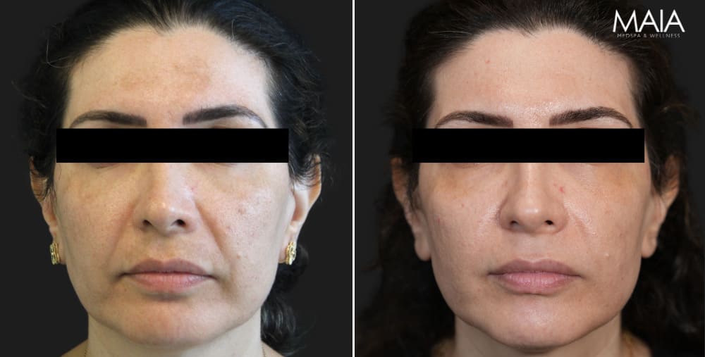 44 year-old patient before and 1 month after HALO and 3 sessions of Microneedling