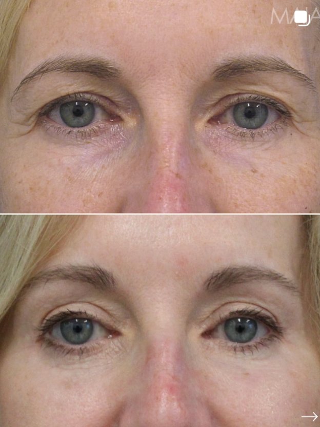 Before and after close-up images of a 57-year-old patient’s eye area showing upper and lower eyelid region following treatment