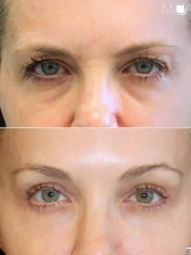 Before and after close-up images of a 49-year-old patient’s eye area showing upper and lower eyelid region following treatment