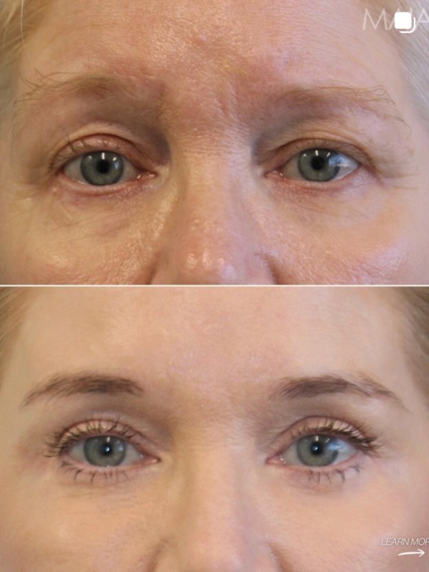 Before and after close-up images of a 60-year-old patient’s eye area showing changes following eyelid-related treatment