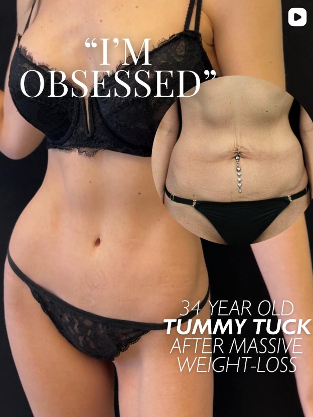Front view of a 34-year-old woman’s torso with an inset image showing a before comparison, related to abdominal surgery after weight loss