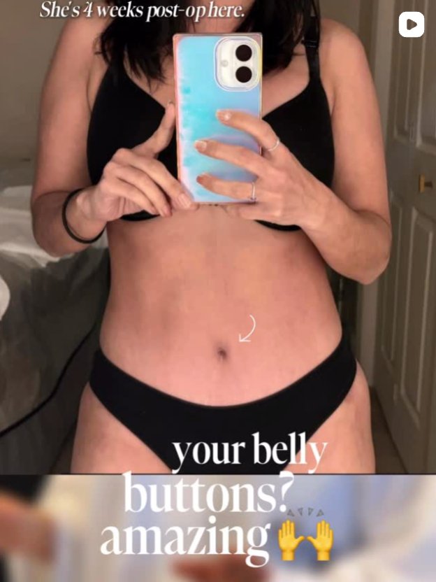 Mirror selfie of a woman’s abdomen taken on a smartphone, showing the midsection four weeks after a procedure