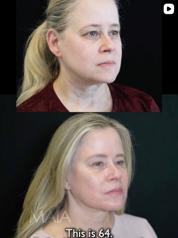 Before and after images of a 64-year-old patient following facial rejuvenation procedures including facelift, neck lift, blepharoplasty, and fat transfer