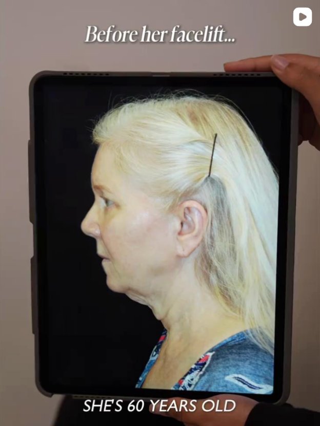 Side profile of a 60-year-old woman shown on a tablet screen, labeled as before facelift