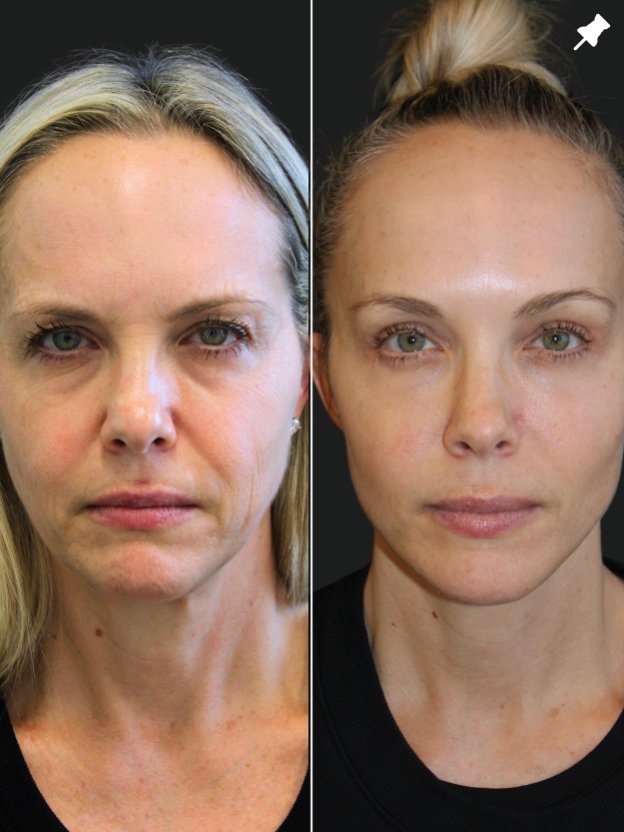 49-year-old patient before facial rejuvenation procedures including facelift, neck lift, upper and lower blepharoplasty, temple lift, and fat grafting