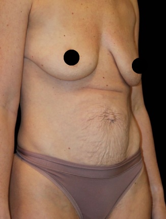 36-year-old patient, before tummy tuck, extended hernia repair and breast lift