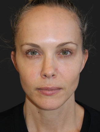 49 year-old patient 6 months after a facelift, neck lift, upper and lower blepharoplasty, temple lift, fat grafting, nanofat grafting, and buccal fat pad removal