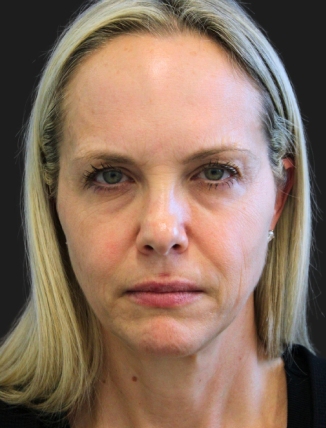49 year-old patient before a facelift, neck lift, upper and lower blepharoplasty, temple lift, fat grafting, nanofat grafting, and buccal fat pad removal