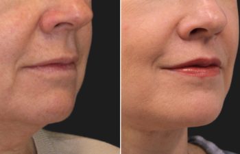 54 year-old before and after the Maia Method (Facial Rejuvenation by Dr. Munique Maia)