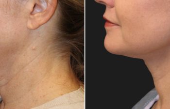 54 year-old before and after the Maia Method (Facial Rejuvenation by Dr. Munique Maia)