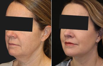 54 year-old before and after the Maia Method (Facial Rejuvenation by Dr. Munique Maia)