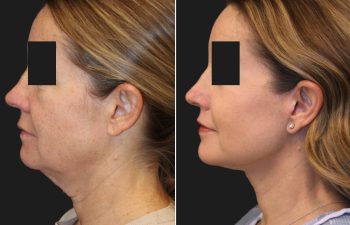 54 year-old before and after the Maia Method (Facial Rejuvenation by Dr. Munique Maia)