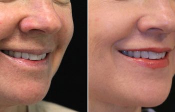 54 year-old before and after the Maia Method (Facial Rejuvenation by Dr. Munique Maia)