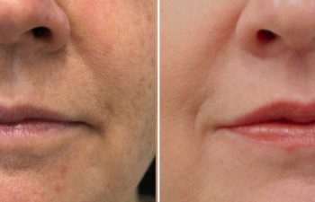 54 year-old before and after the Maia Method (Facial Rejuvenation by Dr. Munique Maia)