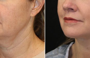 54 year-old before and after the Maia Method (Facial Rejuvenation by Dr. Munique Maia)
