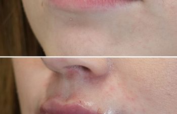 28 year-old before and immediately after lip filler