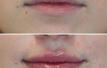 28 year-old before and immediately after lip filler