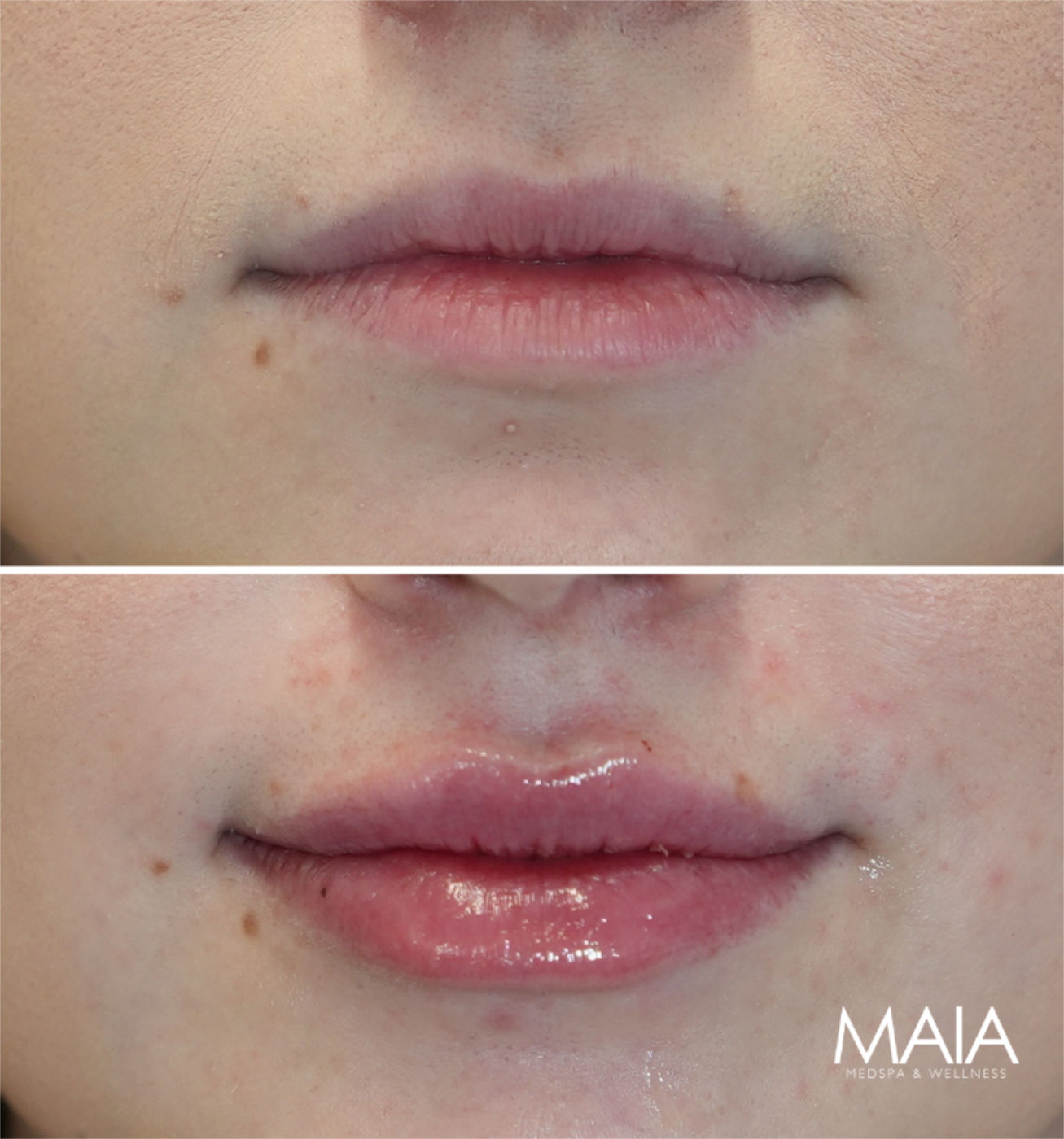 28 year-old before and immediately after lip filler