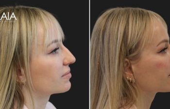 40 year old before immediately and after cheek and chin filler