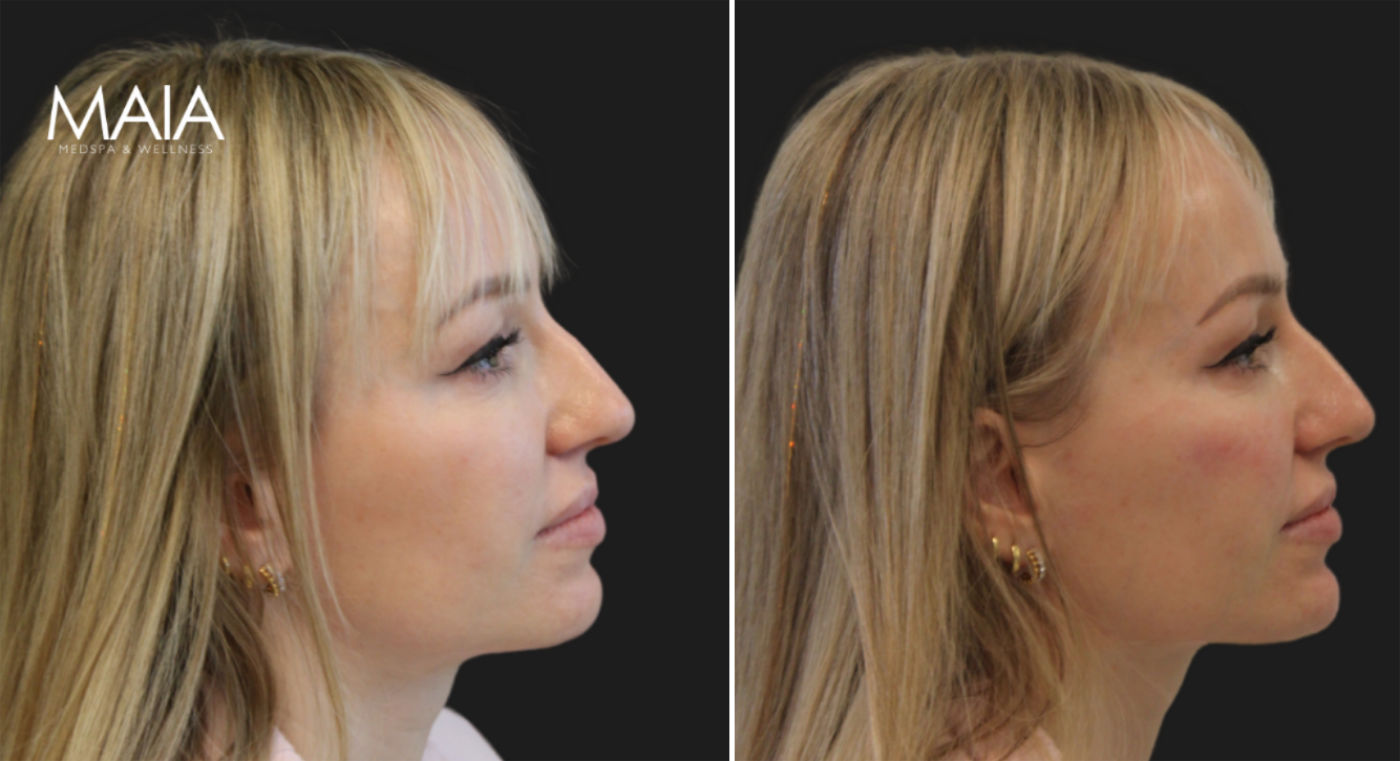 40 year old before immediately and after cheek and chin filler