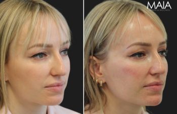 40 year old before immediately and after cheek and chin filler