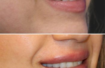 44 year-old before and immediately after lip filler
