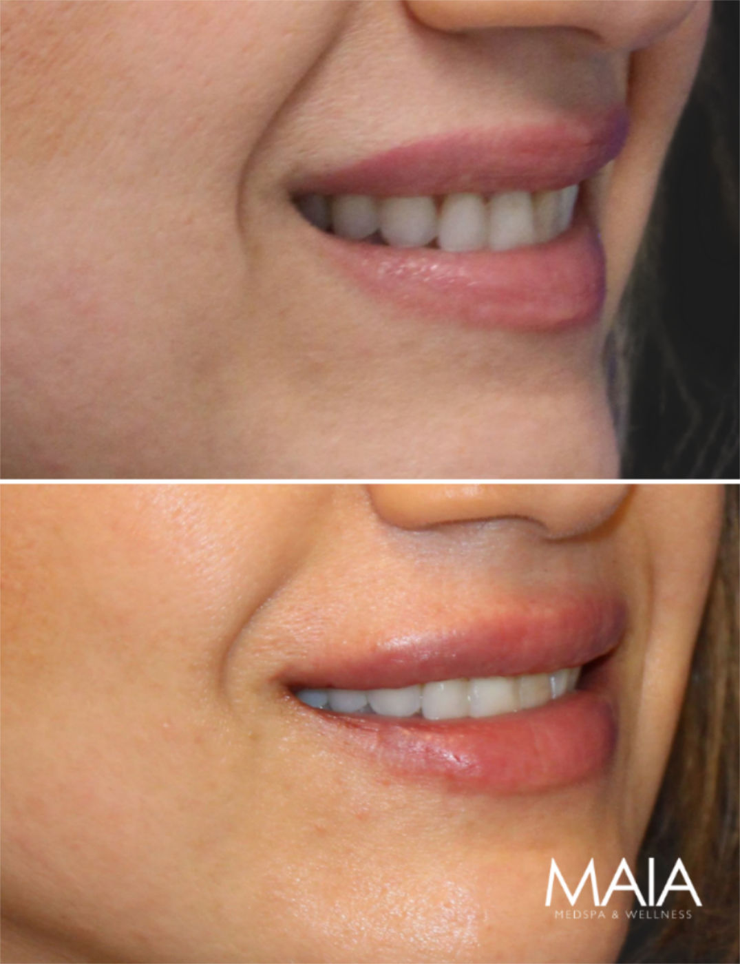 44 year-old before and immediately after lip filler
