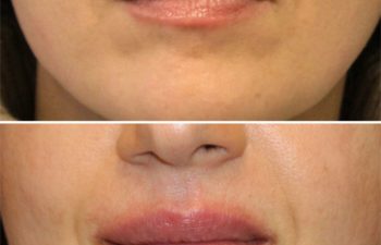 44 year-old before and immediately after lip filler