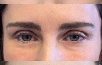 43 year-old patient before and 2 weeks after an upper eyelid lift and mini brow lift