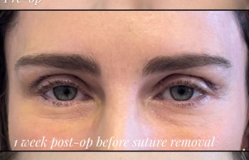 43 year-old patient before and 2 weeks after an upper eyelid lift and mini brow lift