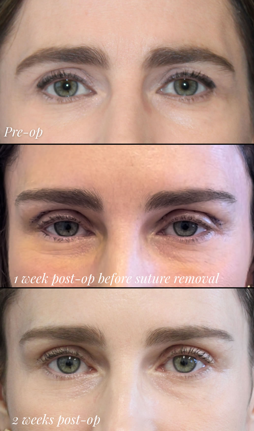 43 year-old patient before and 2 weeks after an upper eyelid lift and mini brow lift