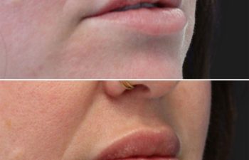 41 year-old before and 2 weeks after lip filler