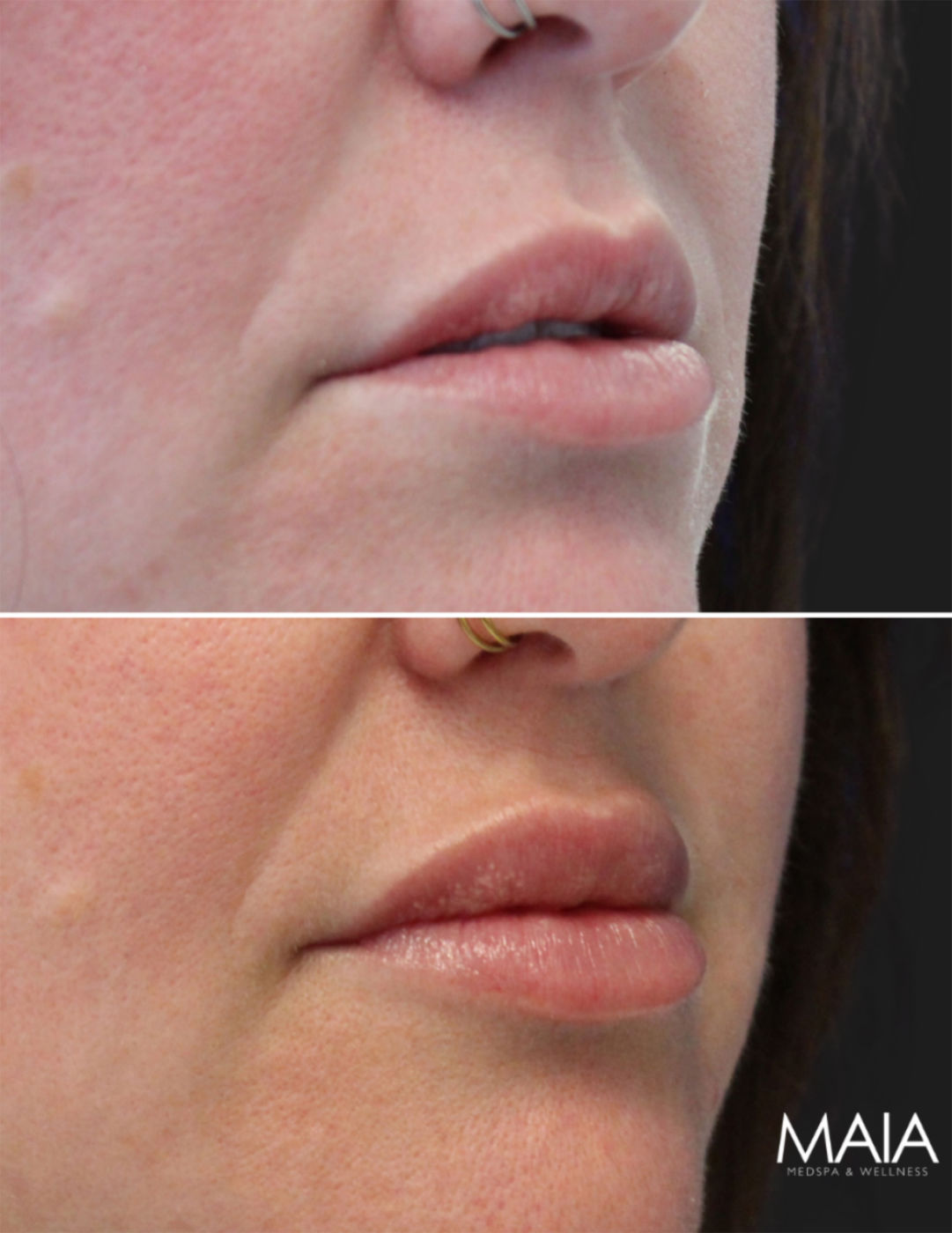 41 year-old before and 2 weeks after lip filler