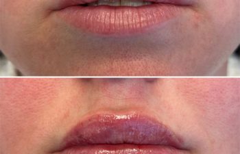 41 year-old before and 2 weeks after lip filler