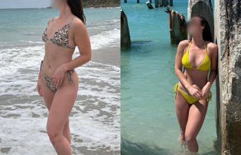 25 year-old before and 7.5 weeks after breast augmentation (300 cc)