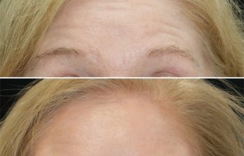 60 year old before and 1.5 weeks after botox