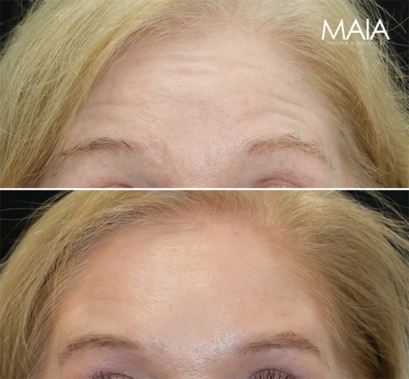 60 year old before and 1.5 weeks after botox