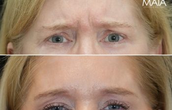 60 year old before and 1.5 weeks after botox