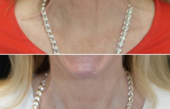 60 year old before and 1.5 weeks after botox