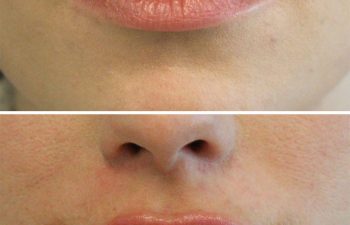 28 year old before and immediately after lip filler
